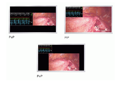 affichage simultané écran bloc opératoire eizo lx491w